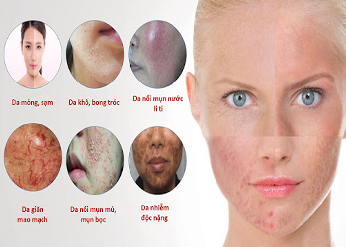 Da mặt bị nhiễm corticoid có nhiều cấp độ khác nhau