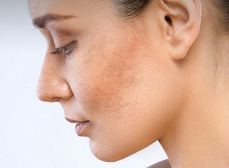 Nám da mặt là sự tăng sinh quá mức sắc tố melanin trên da thường hay xảy ra ở độ tuổi  20-50