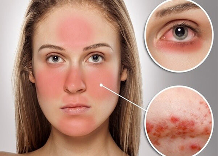 Phản ứng bất lợi khi điều trị nám bằng HQ có thể bị ban đỏ trên vùng da